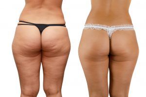 Cellulite before and after