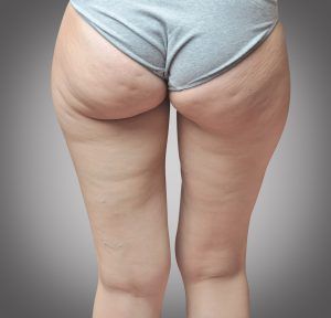 Cellulite at woman buttocks.