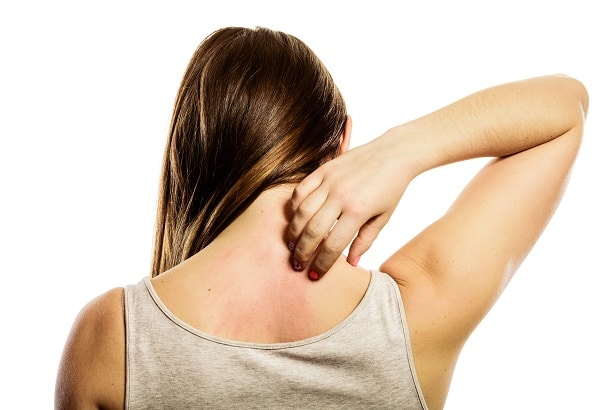 Young woman scratching her itchy back with hives