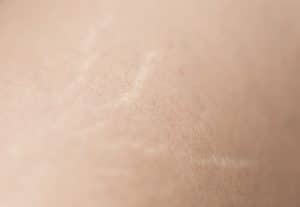 Close Up of Human Skin with Silver Stretch Marks on Surface