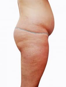 Unwell women with cellulite