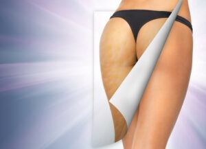 cellulite example