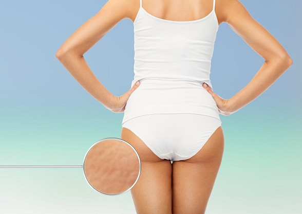how to get rid of cellulite on buttocks naturally